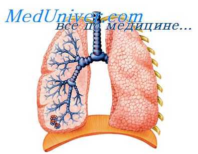 воспаление легких