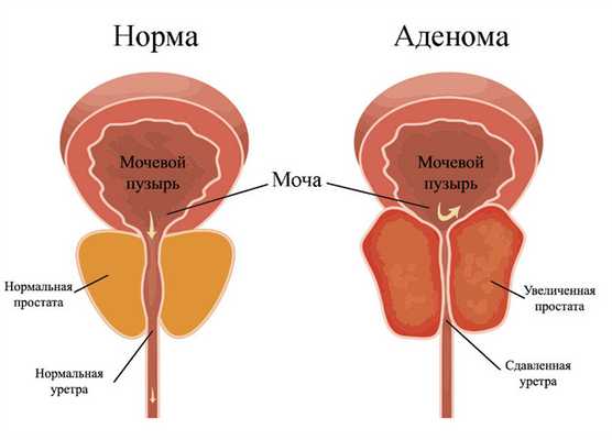 Аденома простаты
