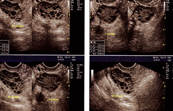 Как выглядит рак яичников
