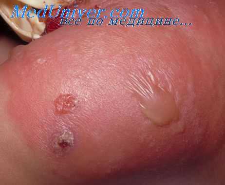 осложнения рожи