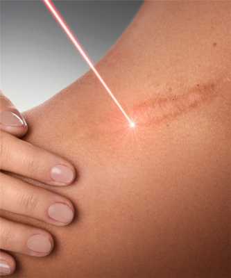 лазерная шлифовка