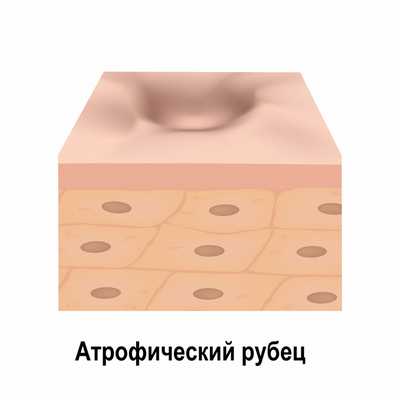 Атрофический рубец.jpg