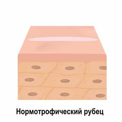 Нормотрофический рубец.jpg