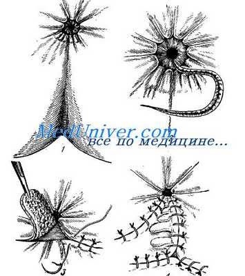 сужения прямой кишки