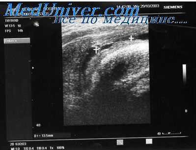 рубцовые стриктуры