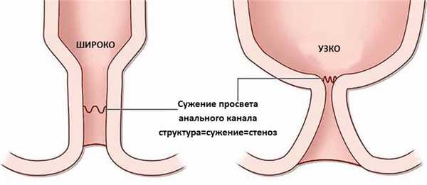 стриктура анального канала, рубцы анального отверстия, рубец после анальной трещины,