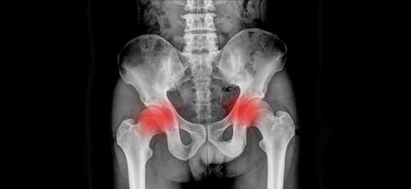 Сакроилеит