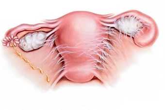 Сактосальпинкс