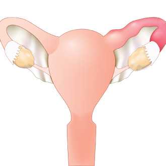 Сальпингит