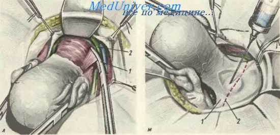Расширенвая экстирпация матки с придатками