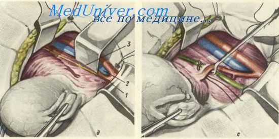 Расширенвая экстирпация матки с придатками