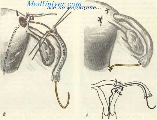 Имплантация проходимой части трубы в матку