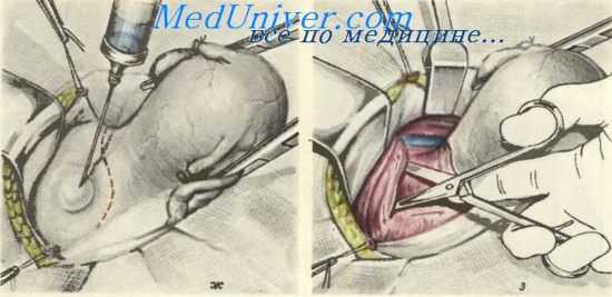 Расширенвая экстирпация матки с придатками