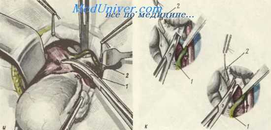 Расширенвая экстирпация матки с придатками