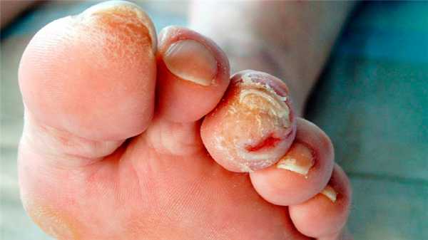 Лечение хронических ран. Диабетическая стопа. Стерильно.com