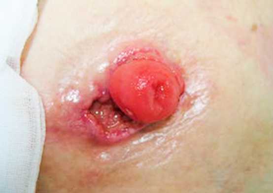 Стома в ране