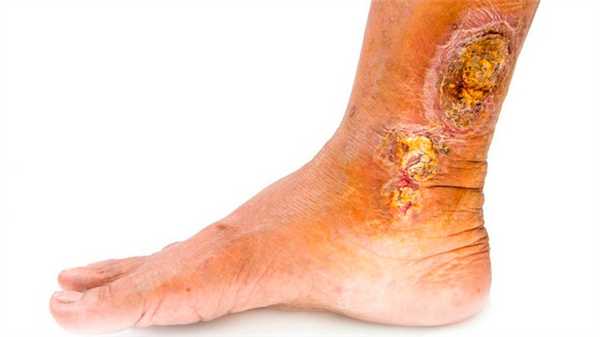 Лечение хронических ран. Трофические язвы. Стерильно.com