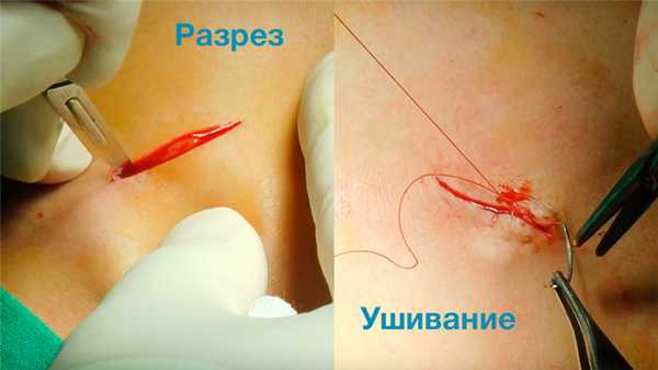 Послеоперационная рана. фото. Стерильно.com
