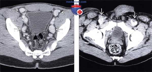 Лучевые изменения брюшной полости при саркоме Капоши