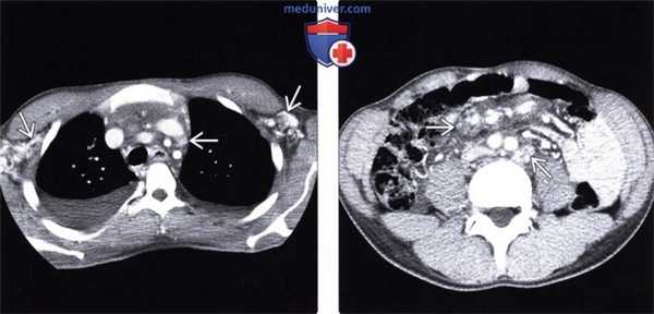 Лучевые изменения брюшной полости при саркоме Капоши