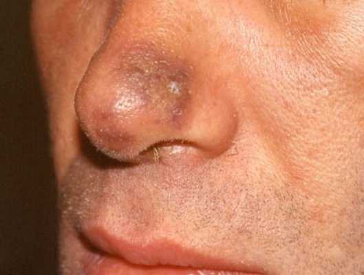 Саркома Капоши в начальной стадии