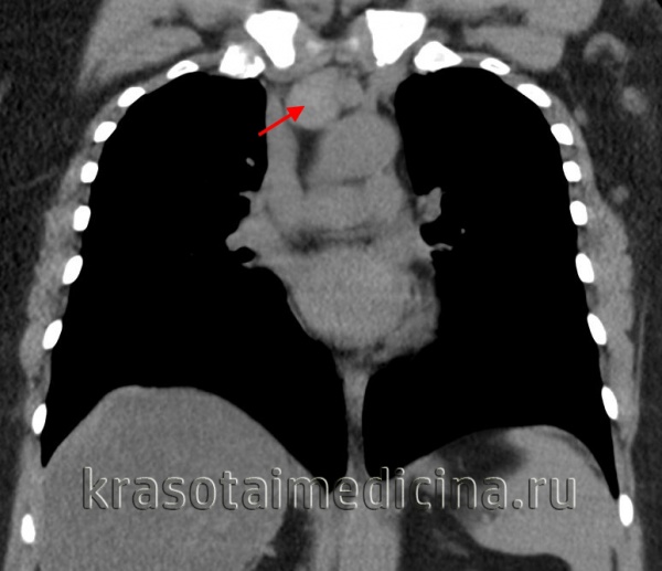 Злокачественные опухоли легких