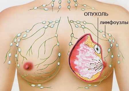 Саркома грудной железы