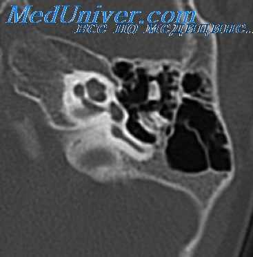 саркома среднего уха