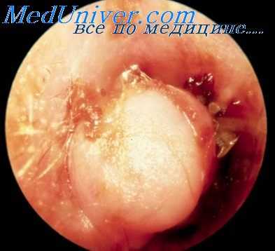 рак среднего уха