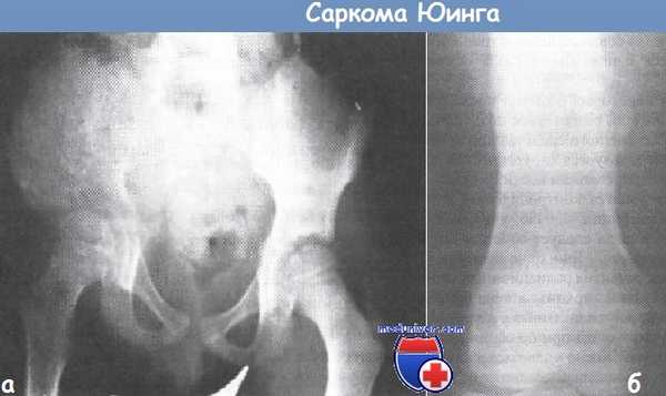 Саркома Юинга