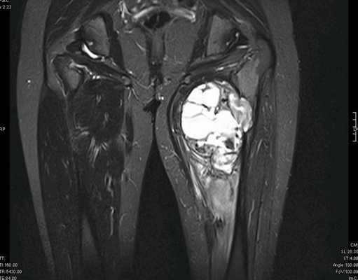 Как выглядит саркома на УЗИ