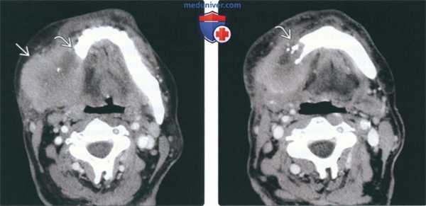 КТ, МРТ при саркоме жевательного пространства