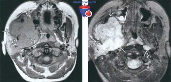 КТ, МРТ при саркоме жевательного пространства