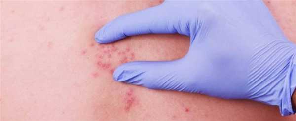 Аденокарцинома кожи