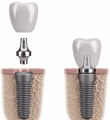 Установка импланта в один этап