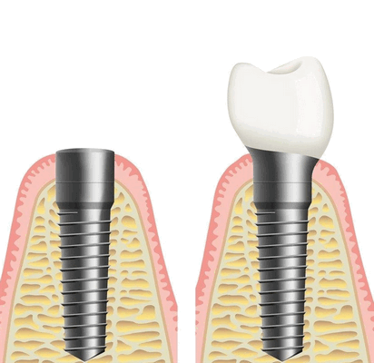 Ортопедический этап, формирование десны и установка коронки