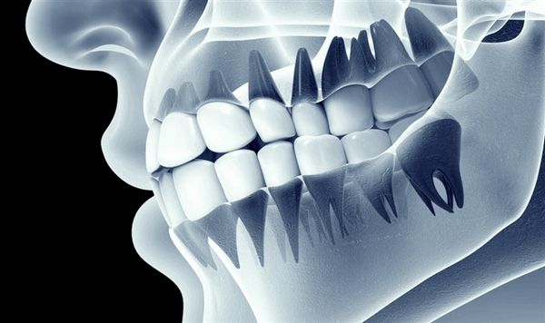 Проверка межзубного расстояния