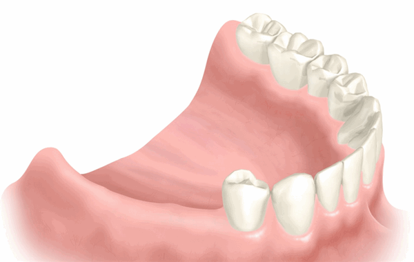 Концевой дефект зубного ряда, отсутствуют последние моляры