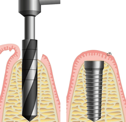 Вживление имплантата, хирургический этап классической имплантации