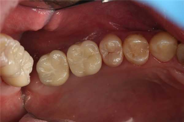 Установка протезов и завершение двухэтапной имплантации