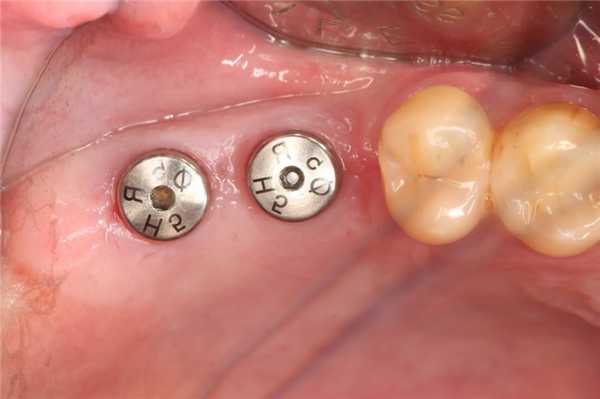 Установка имплантов по двухэтапной методике