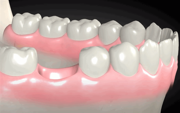 Одиночный дефект зубного ряда