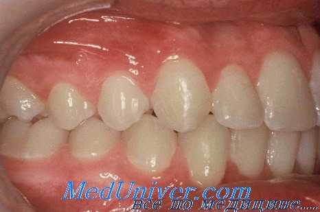 сбой окклюзии в стоматологии