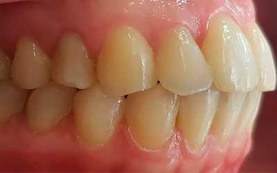 Причины окклюзии - Линия Улыбки