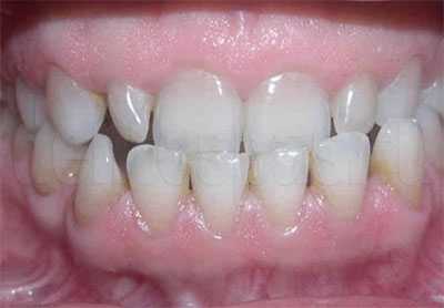 Cагиттальное (мезиальное) нарушение окклюзии