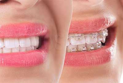 Лечение брекетами