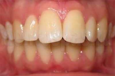 Cагиттальное (дистальное) нарушение окклюзии