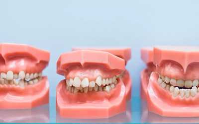 Проблема окклюзии в стоматологии - Линия Улыбки