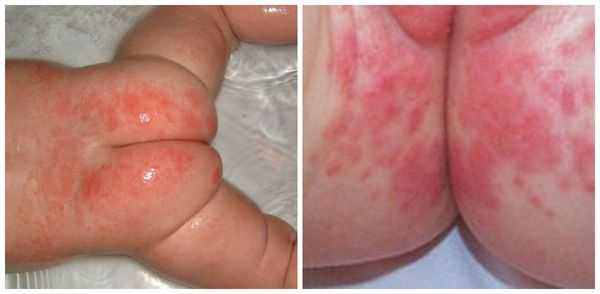 Простой пелёночный дерматит