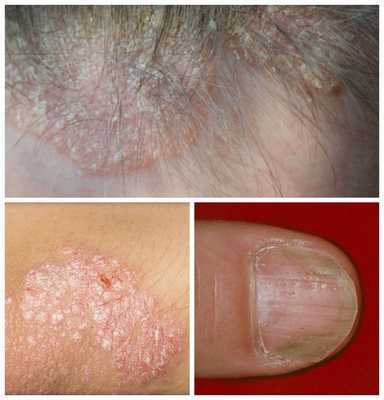 Признаки псориаза